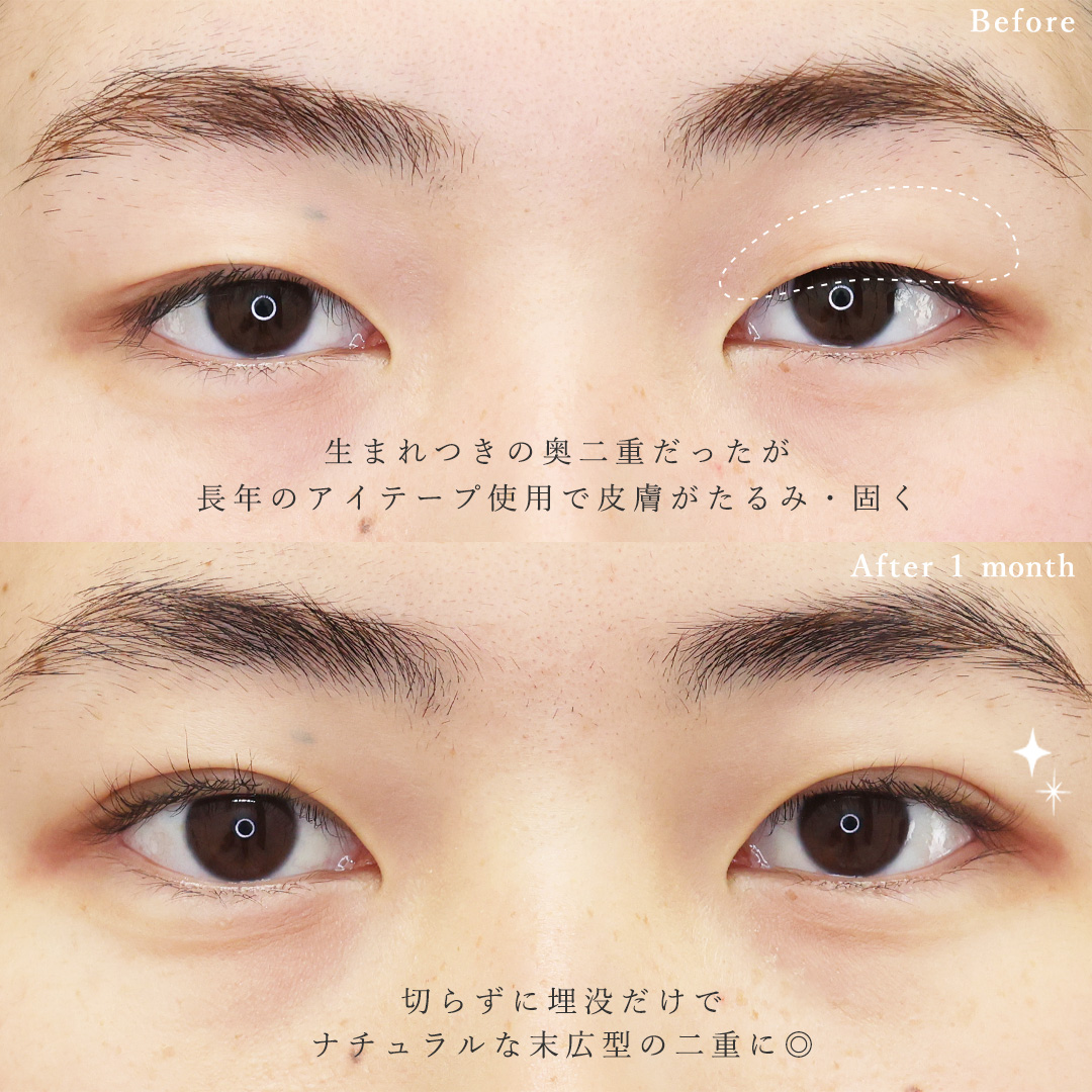 二重埋没法の症例写真 施術前後 
