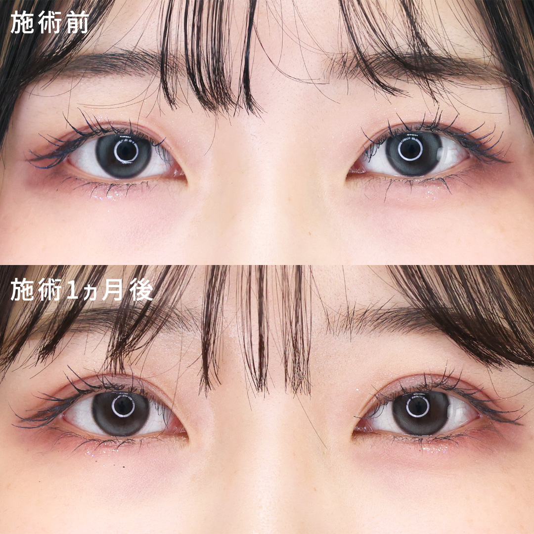 学割でお得に！ぱっちりMix型二重【お目元の印象UP】