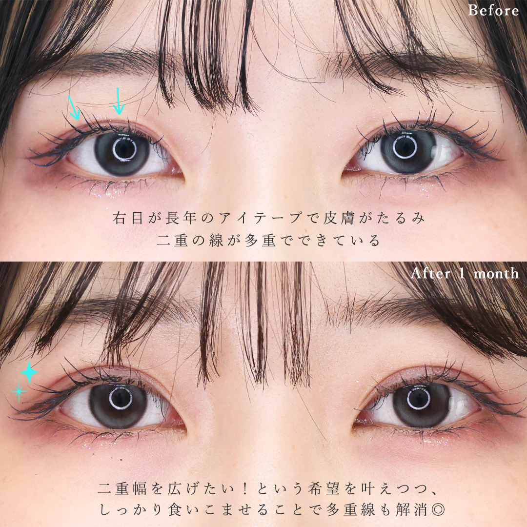 二重埋没法の症例写真 施術前後 