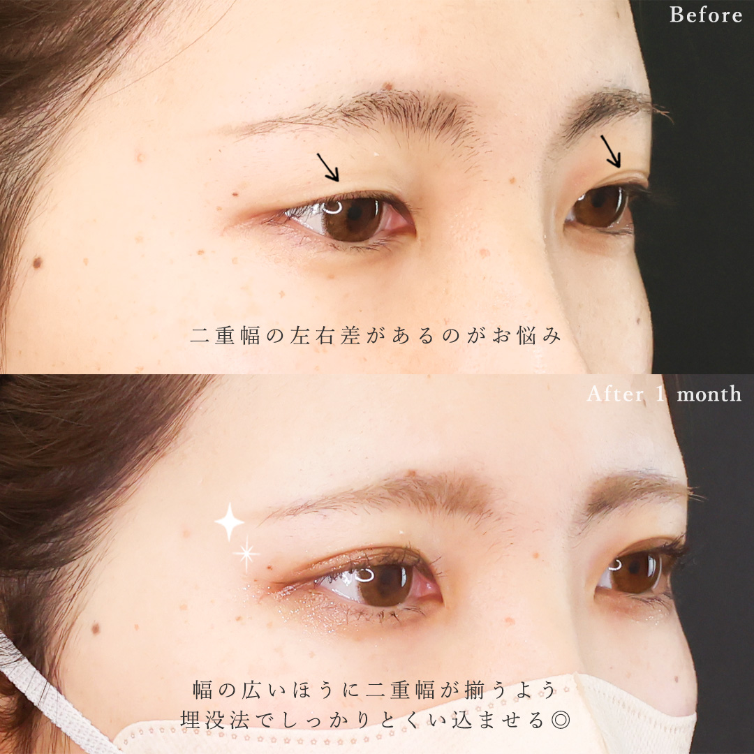 二重埋没法の症例写真 施術前後 