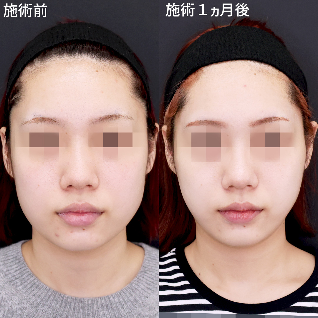 【糸リフト】でナチュラルに輪郭洗練