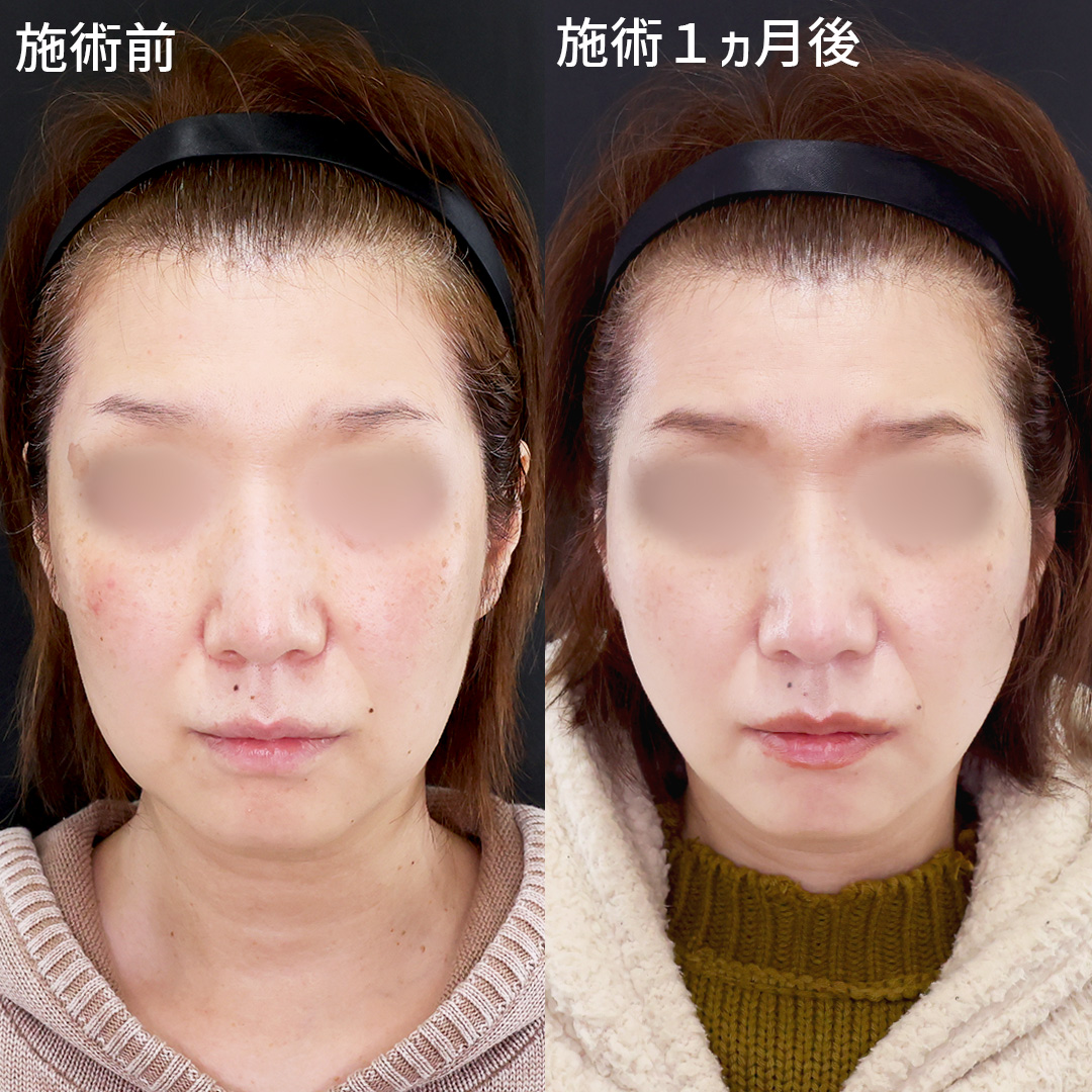 TAC式 ツヤ肌コラーゲンリフト®の症例写真 施術前後 