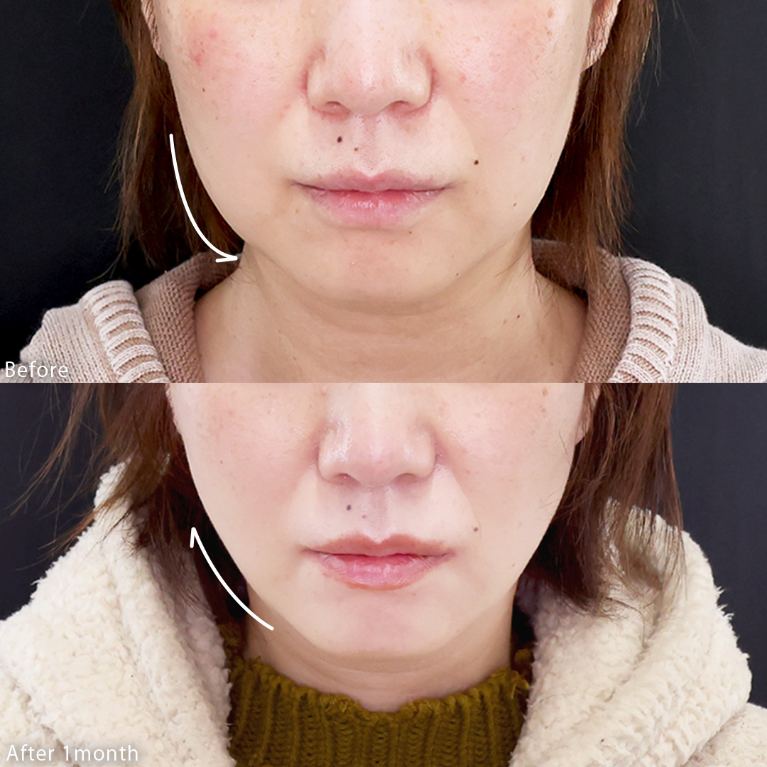 TAC式 ツヤ肌コラーゲンリフト®の症例写真 施術前後 