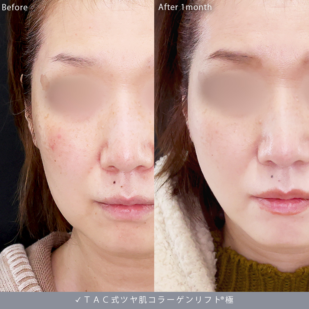 TAC式 ツヤ肌コラーゲンリフト®の症例写真 施術前後 