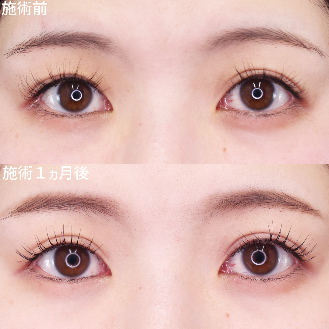 【埋没法】で華やか平行二重に