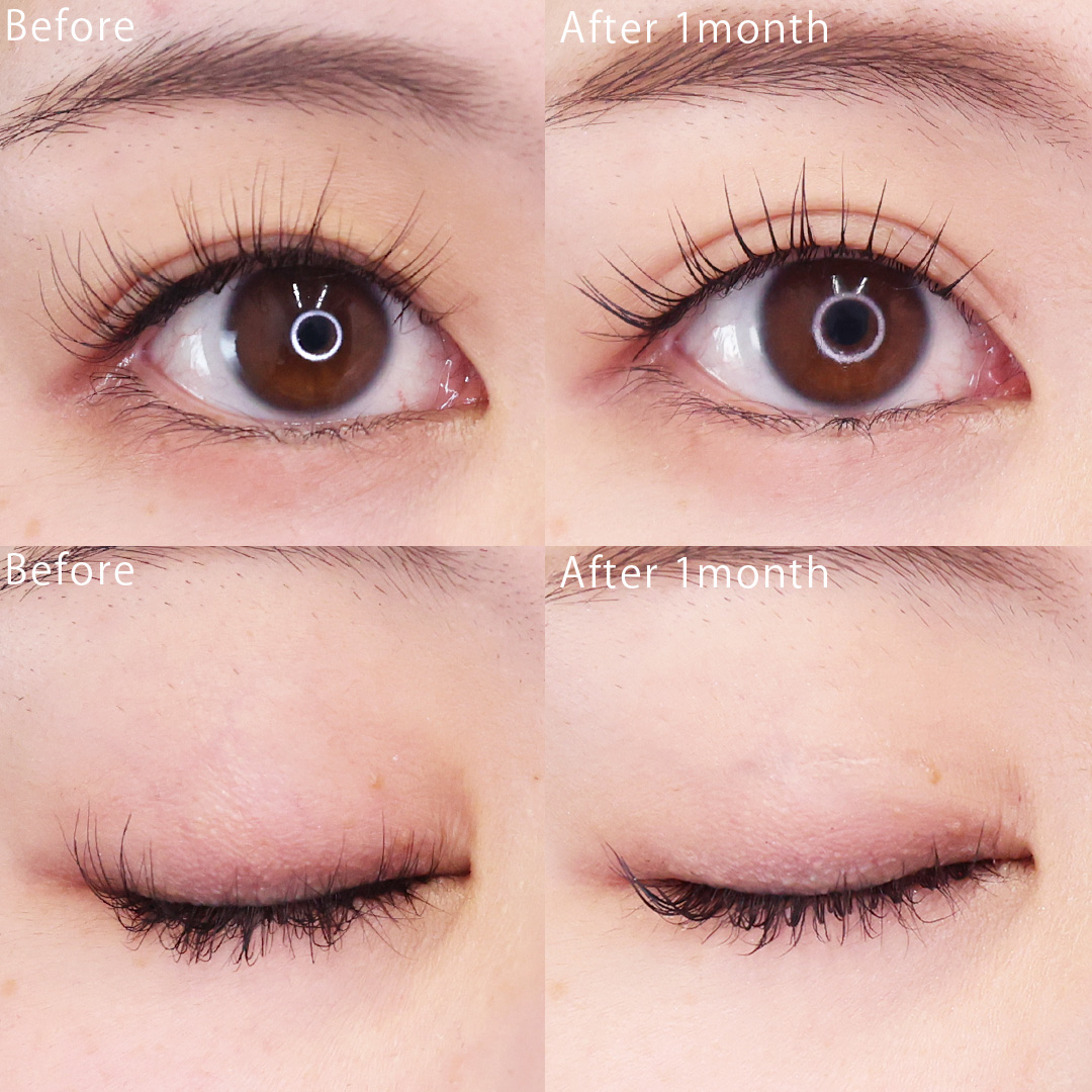 二重埋没法の症例写真 施術前後 