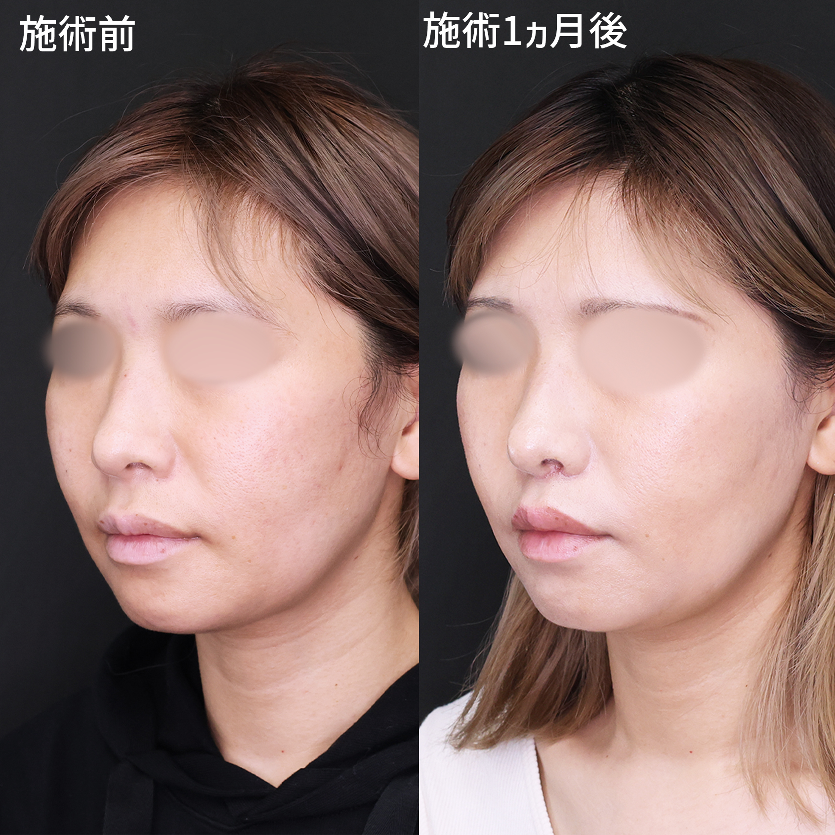 人中短縮術(リップリフト)・外側人中短縮術の症例写真 施術前後 