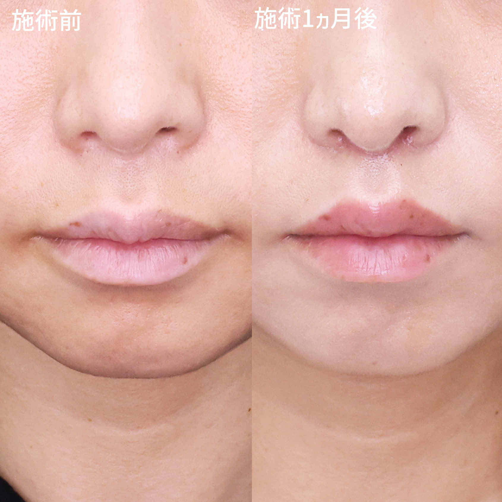 【人中短縮術】でお顔のバランスを整える