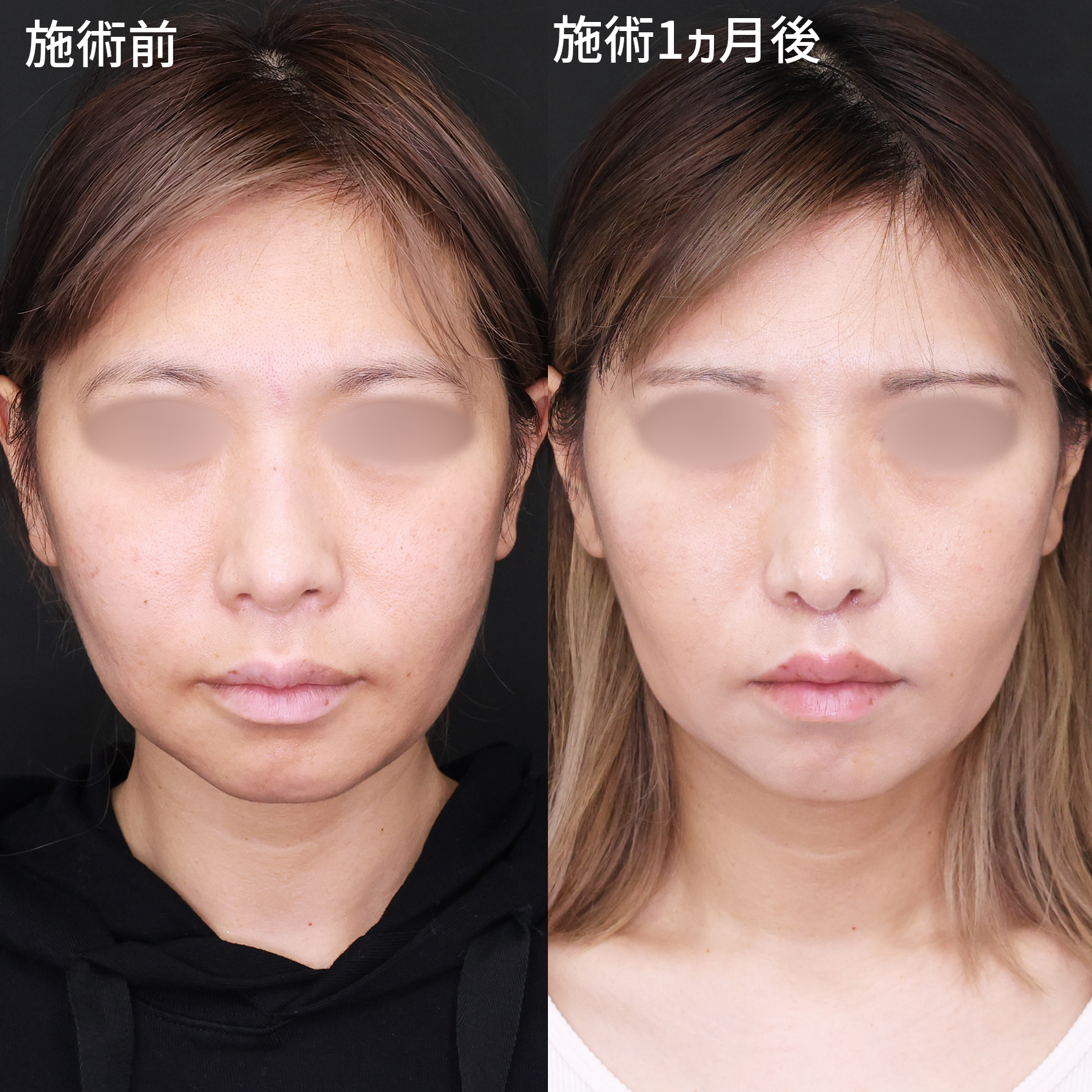 人中短縮術(リップリフト)・外側人中短縮術の症例写真 施術前後 