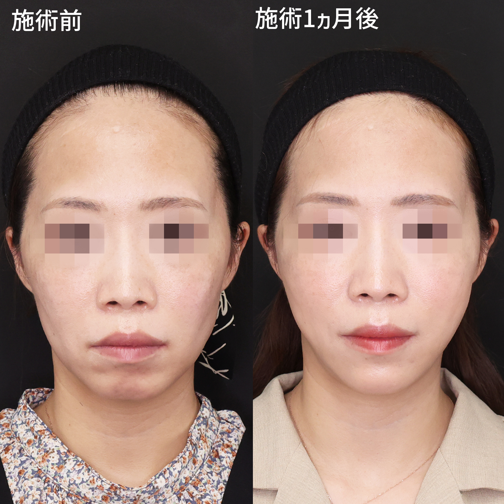 【糸リフト】で自然に若返り