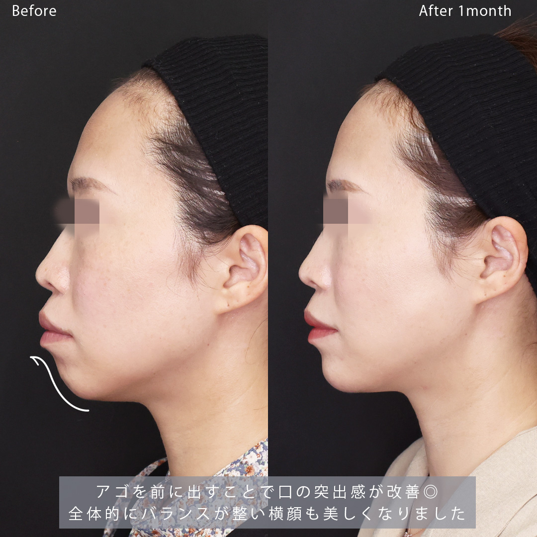 TAC式 ツヤ肌コラーゲンリフト®/顎のヒアルロン酸注射/ボトックス注射：その他の症例写真 施術前後 