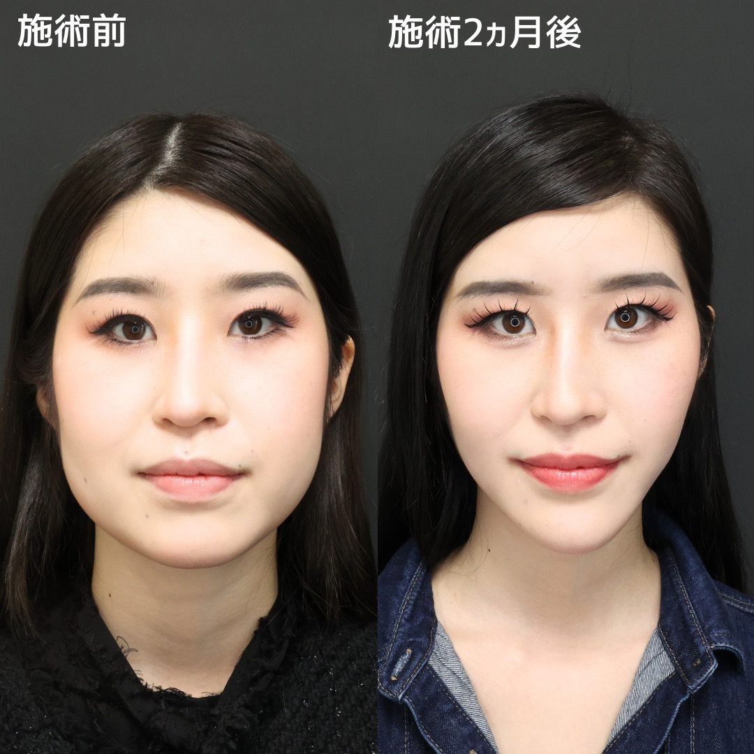 《驚異の変化率》別人級小顔になりたい方はDr.MARIEまで