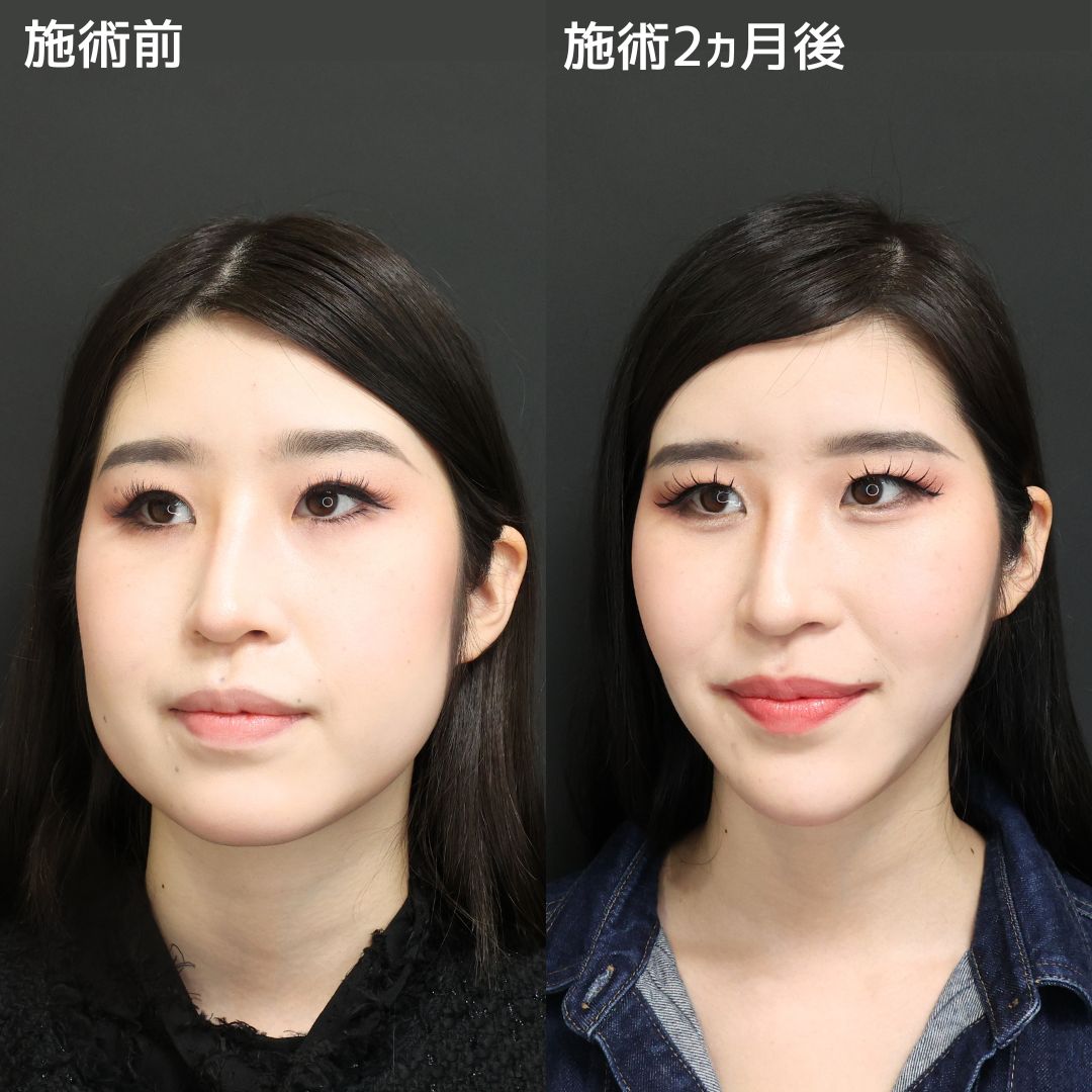 TAC式 ツヤ肌コラーゲンリフト®/バッカルファット除去/ジョールファット除去の症例写真 施術前後 