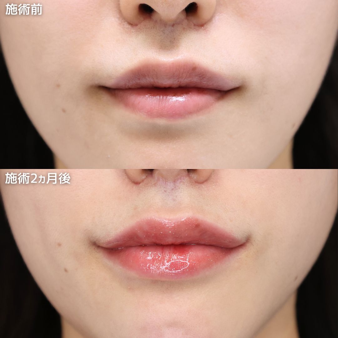 《口角リフト》整形感なくナチュラルなモテリップ