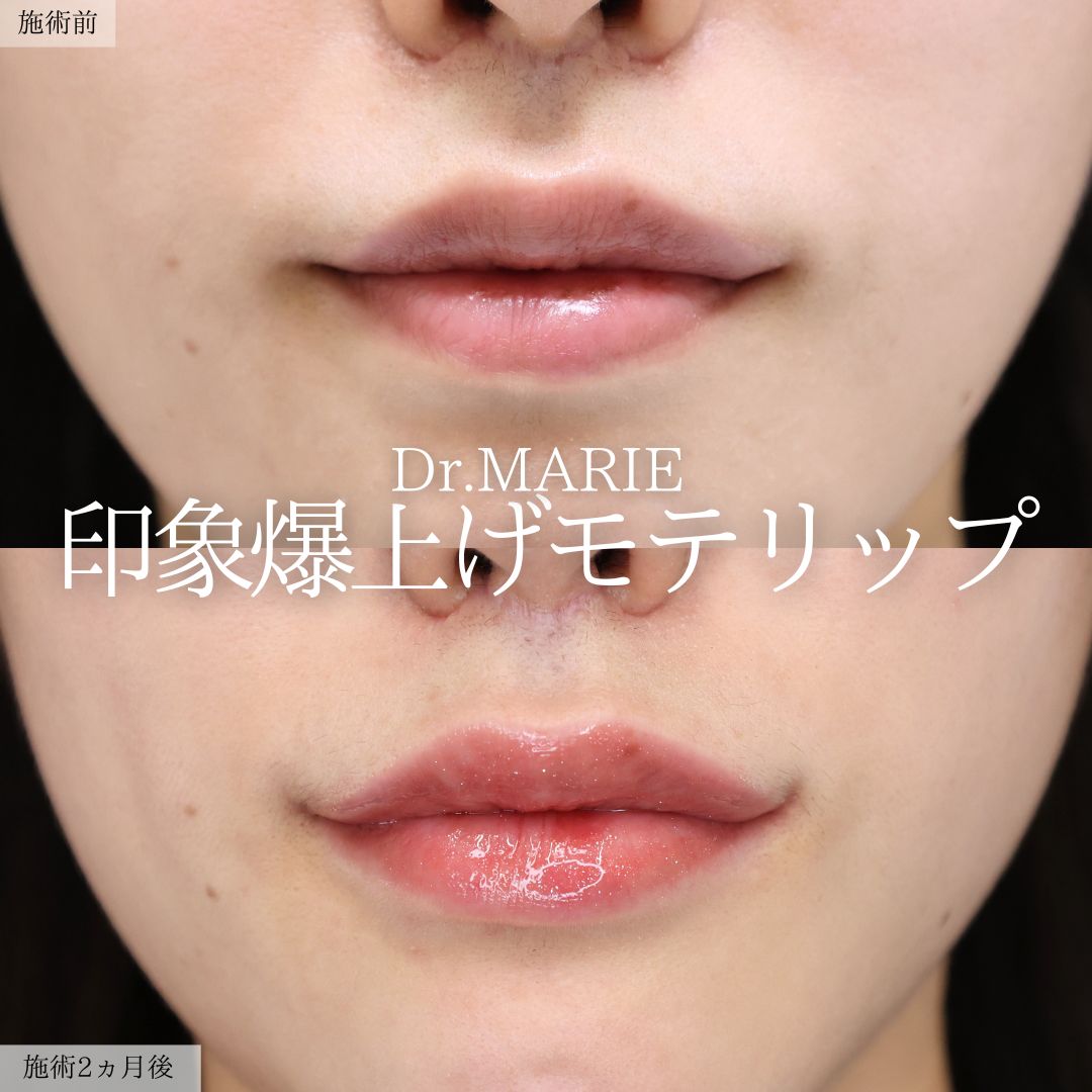口角挙上・リフト（マイクロ切開法・内側法/口内法）の症例写真 施術前後 