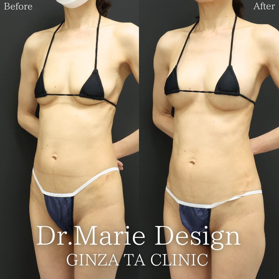 ヒアルロン酸注入豊胸術（グラビアバスト）の症例写真 施術前後 