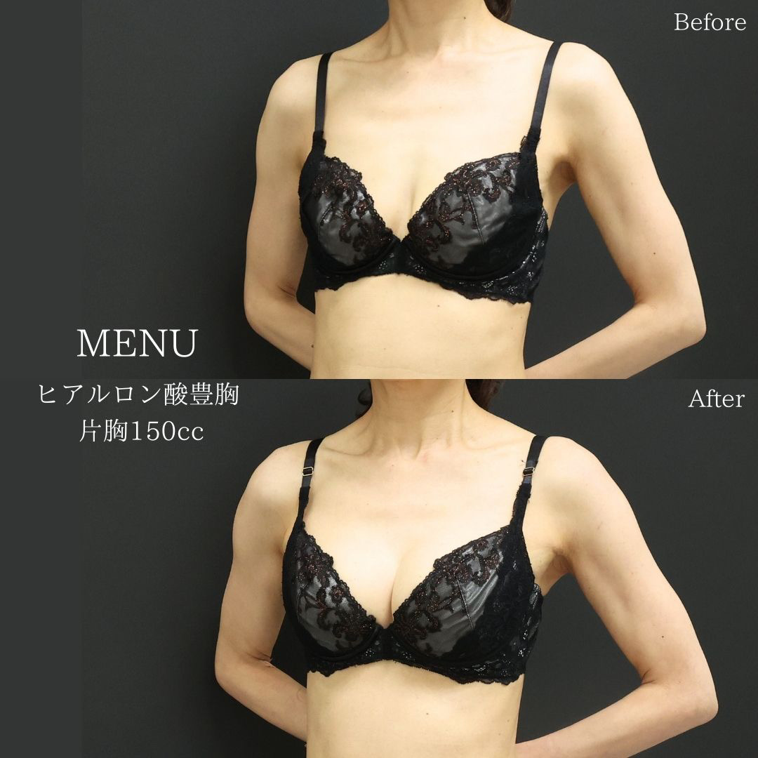 ヒアルロン酸注入豊胸術（グラビアバスト）の症例写真 施術前後 