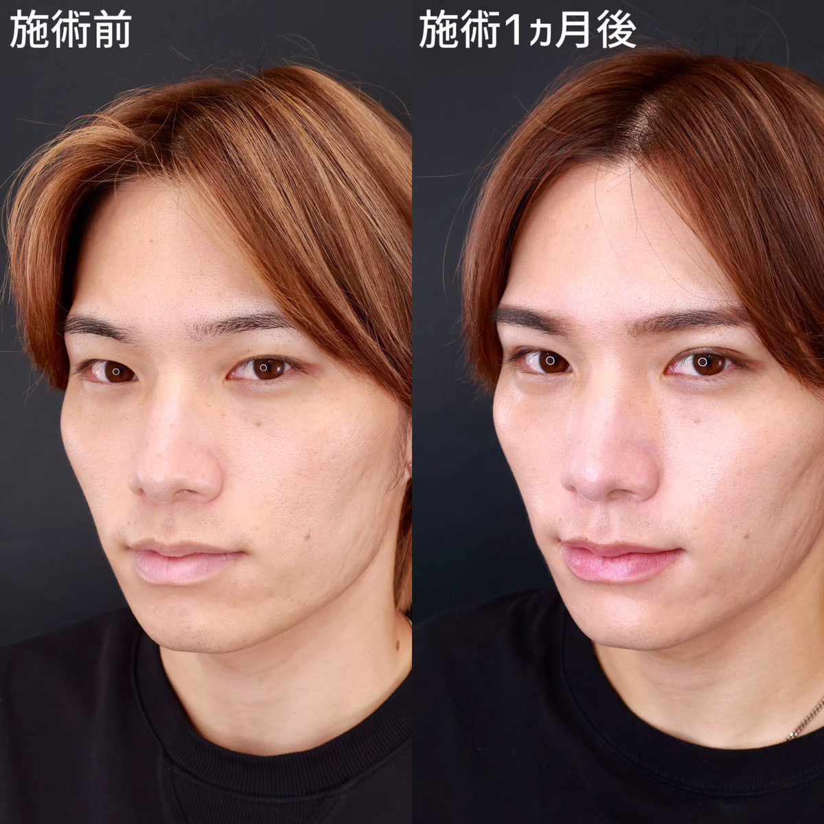 TAC式 ツヤ肌コラーゲンリフト®/二重埋没法/おでこボトックス注射の症例写真 施術前後 