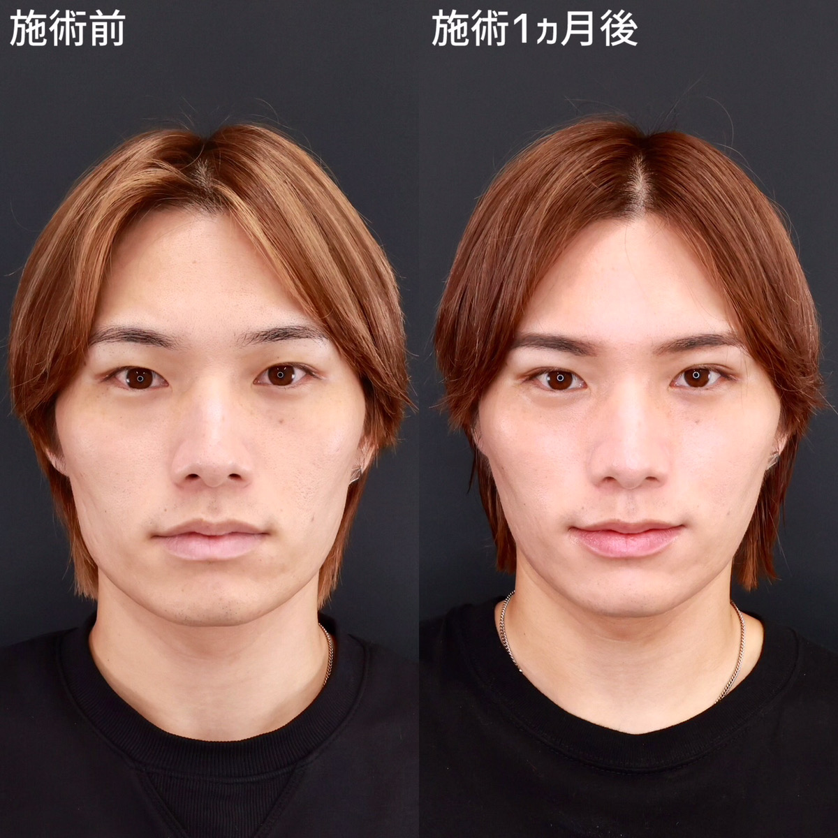 【複合施術】イケメン爆誕！自然で垢抜けた印象に！