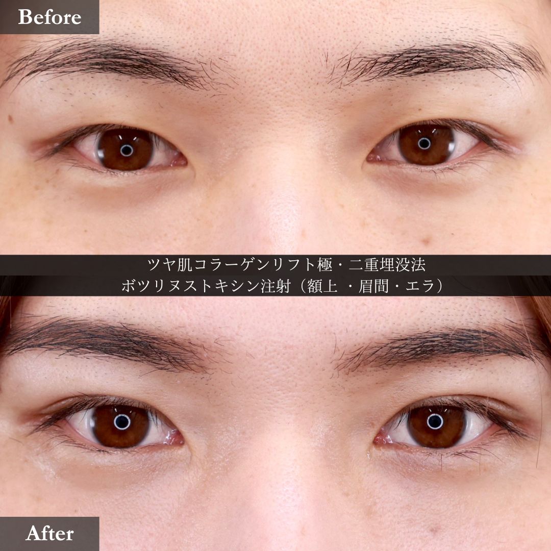 TAC式 ツヤ肌コラーゲンリフト®/二重埋没法/おでこボトックス注射の症例写真 施術前後 