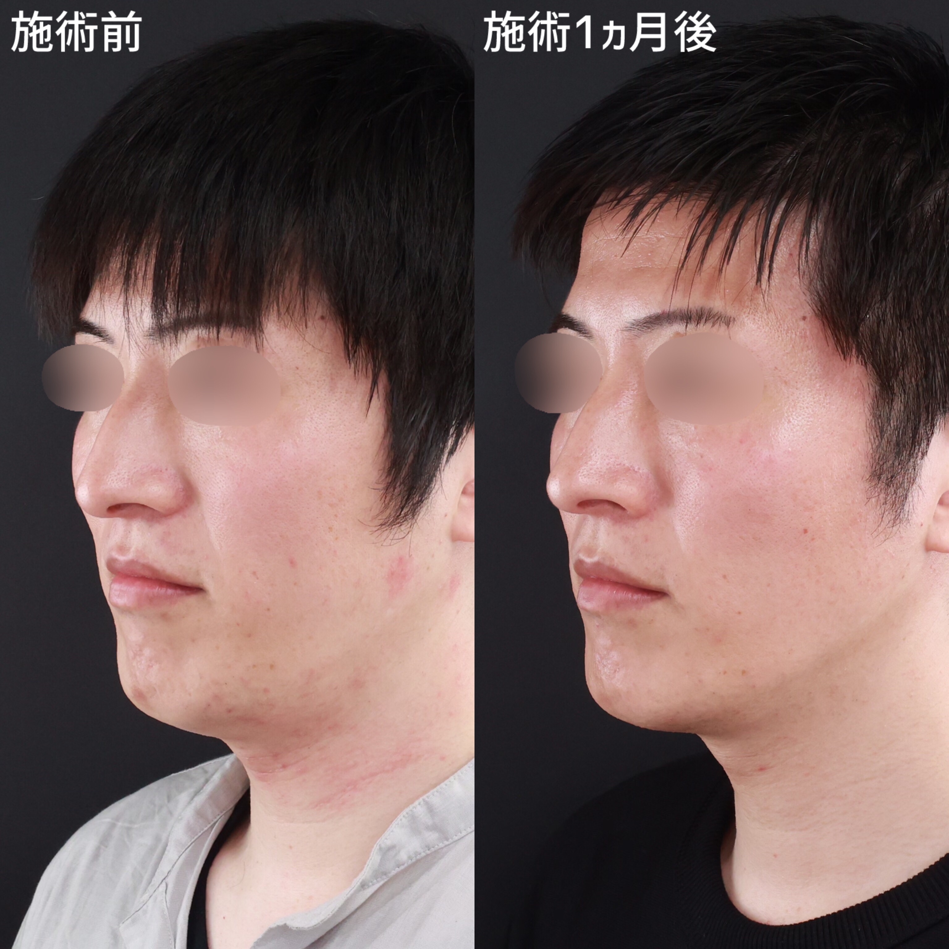 【糸リフト】フェイスラインをスッキリとシャープな印象に