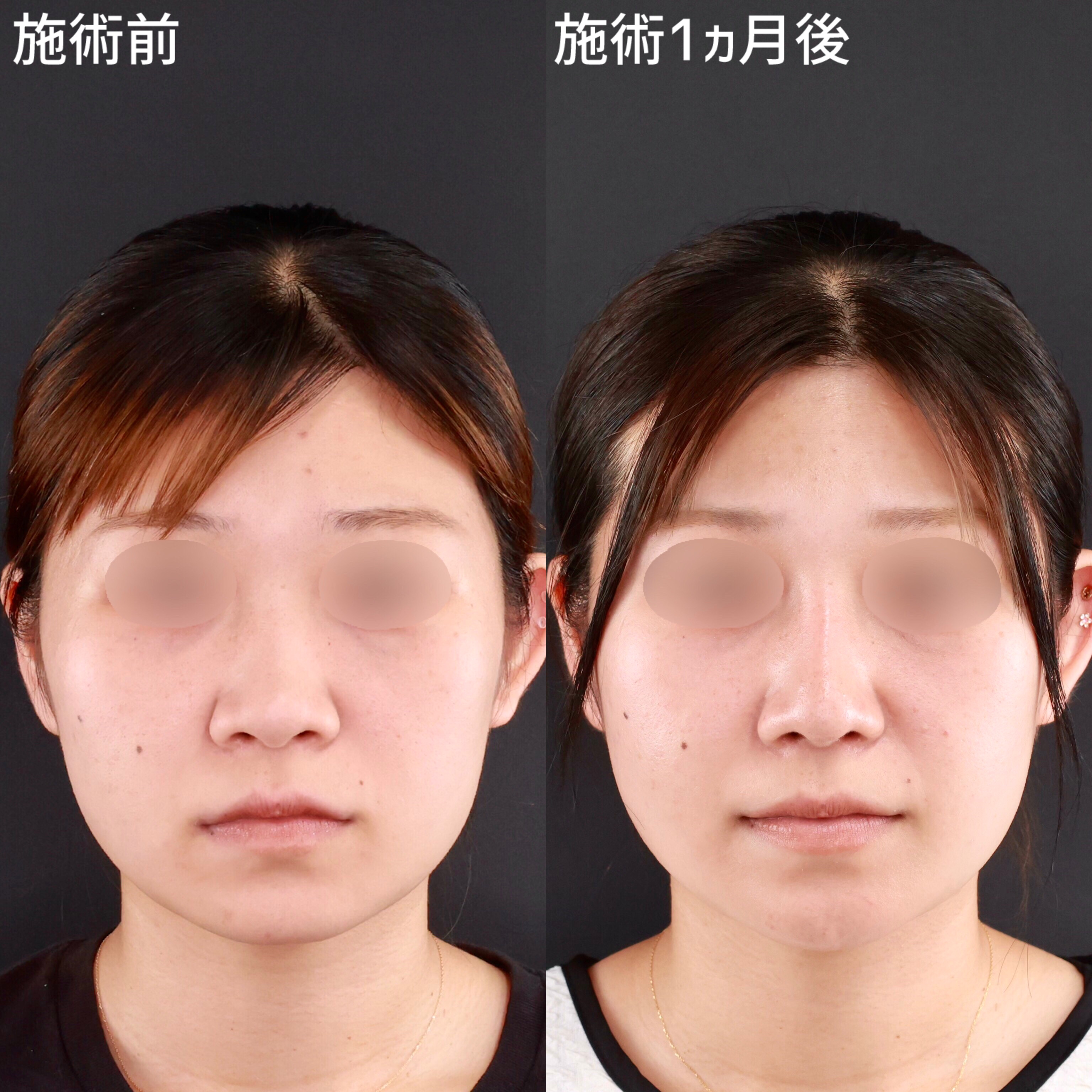 鼻尖形成・鼻尖縮小/隆鼻術（プロテーゼ・自家組織）/鼻先軟骨移植の症例写真 施術前後 