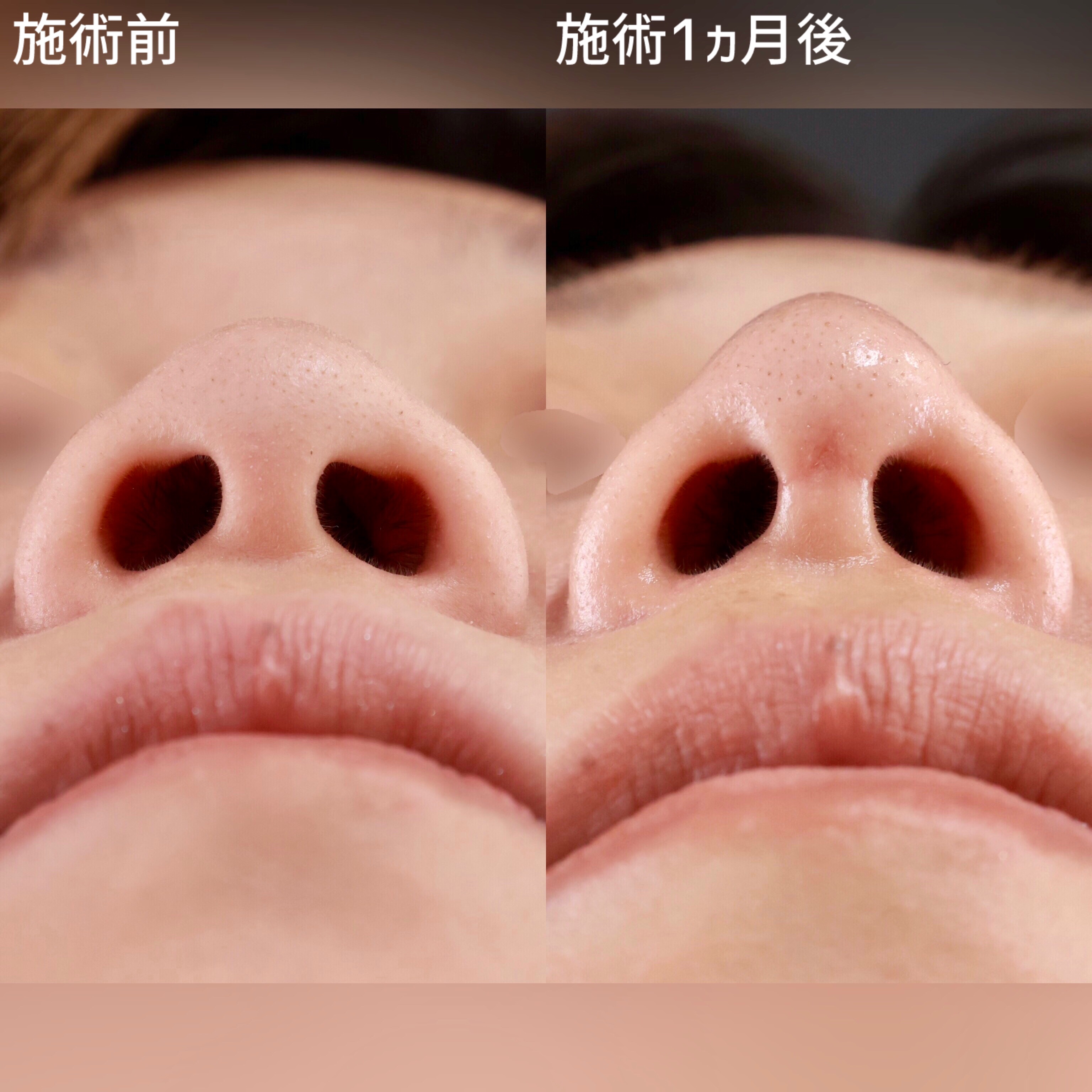 鼻尖形成・鼻尖縮小/隆鼻術（プロテーゼ・自家組織）/鼻先軟骨移植の症例写真 施術前後 