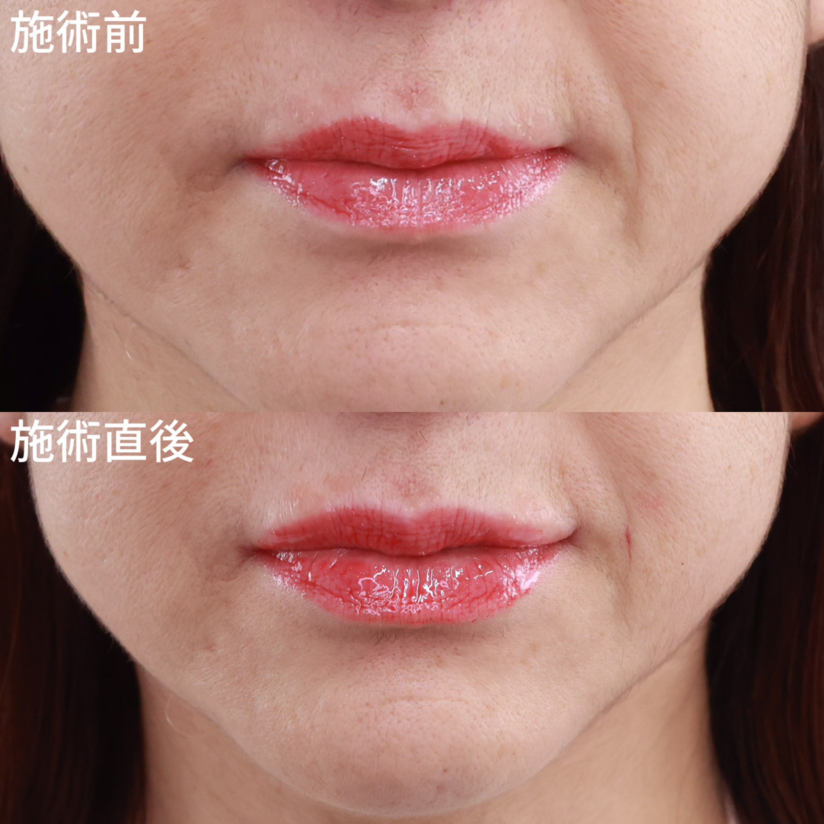 【ヒアルロン酸注射】口角をキュッと上向きに