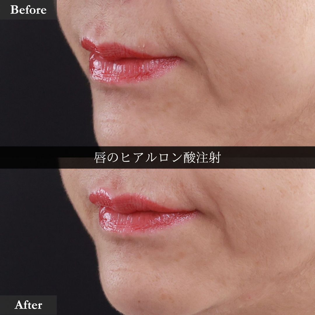 ヒアルロン酸注射:その他の症例写真 施術前後