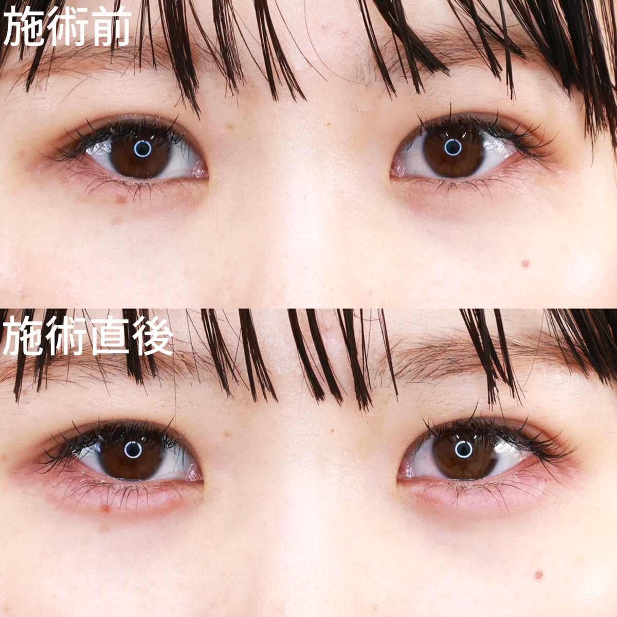 【涙袋ヒアルロン酸】ぷっくりとした涙袋で、目元に立体感を出す！