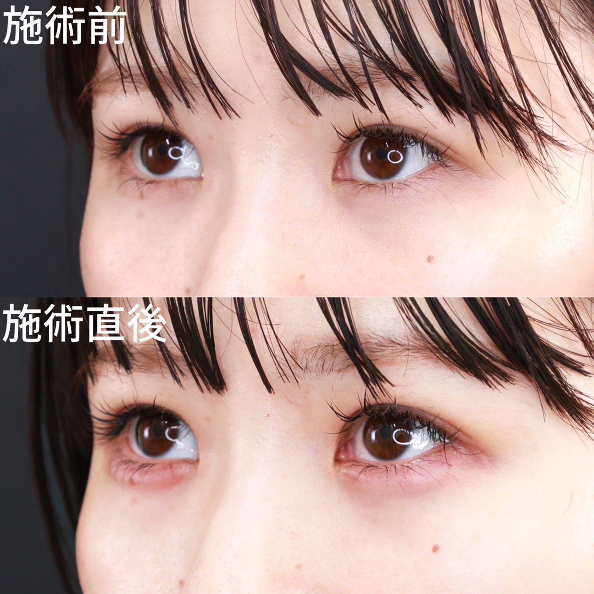 涙袋形成（ヒアルロン酸注射）の症例写真 施術前後 