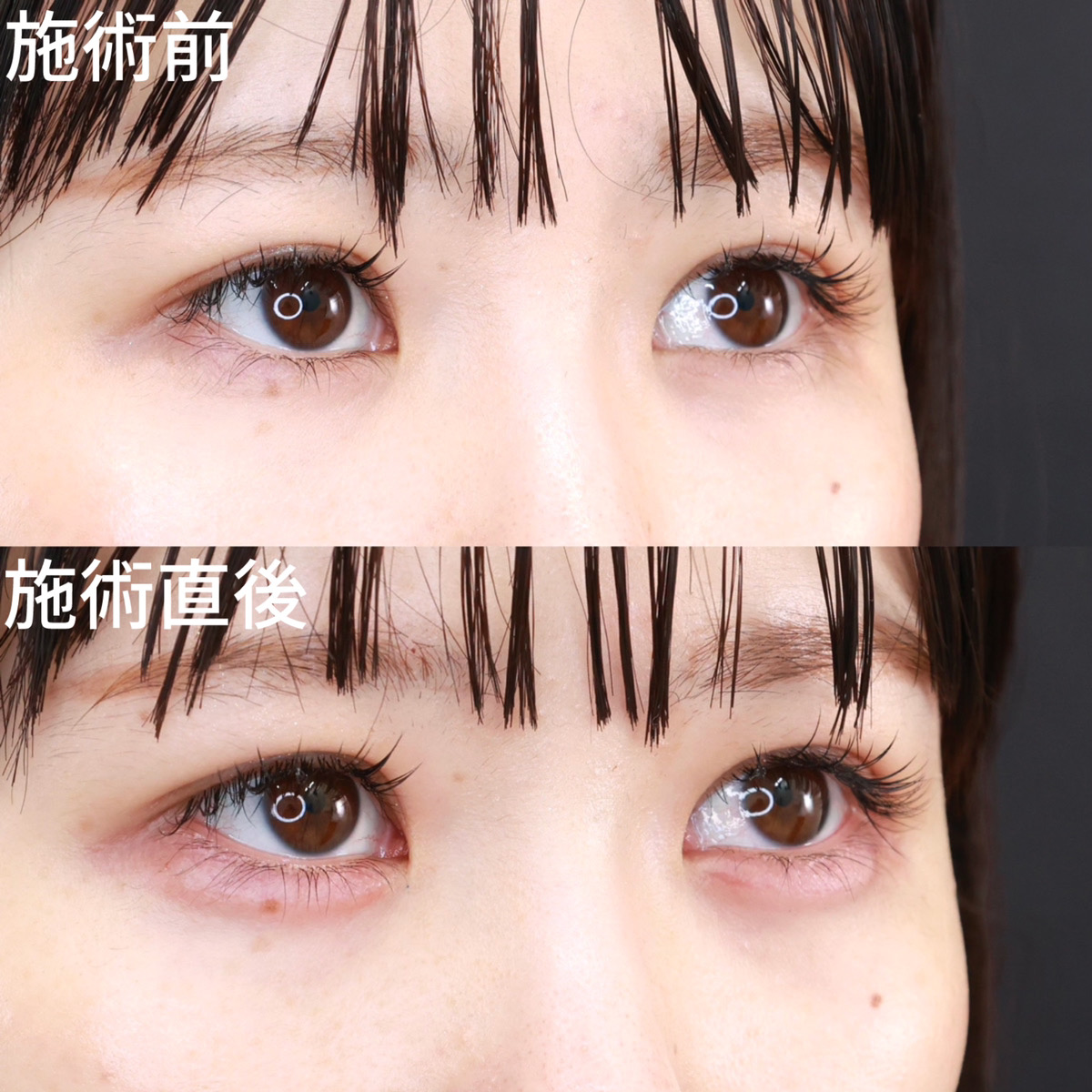 涙袋形成（ヒアルロン酸注射）の症例写真 施術前後 