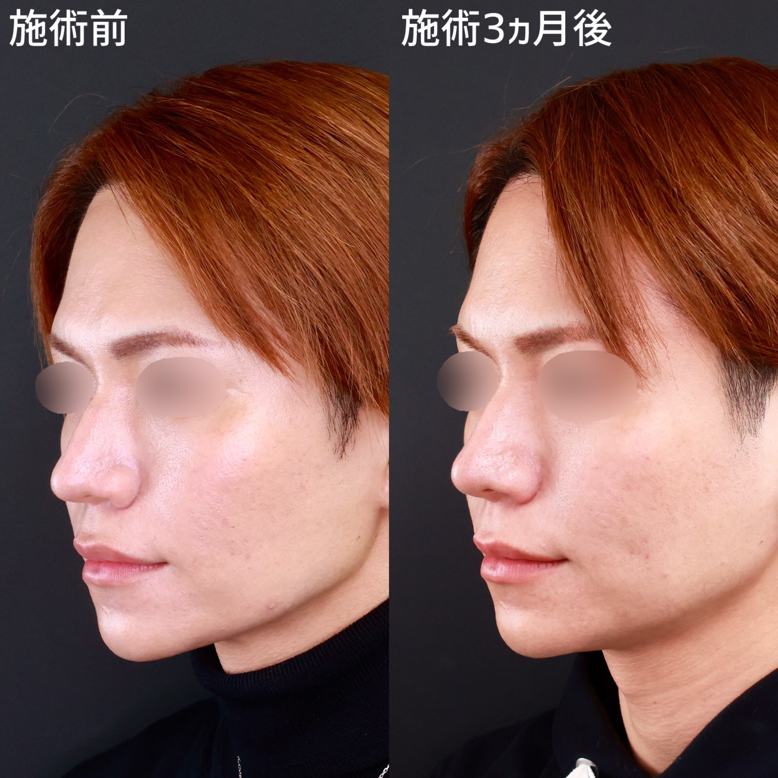 【鼻整形】ACRの関係を整えてバランスの良い鼻に