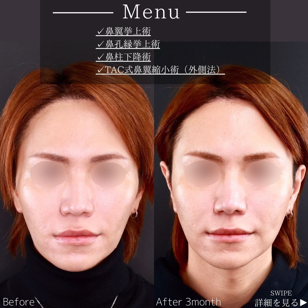 鼻孔縁挙上術/鼻翼挙上術/TAC式 鼻翼縮小術（小鼻縮小）の症例写真 施術前後 