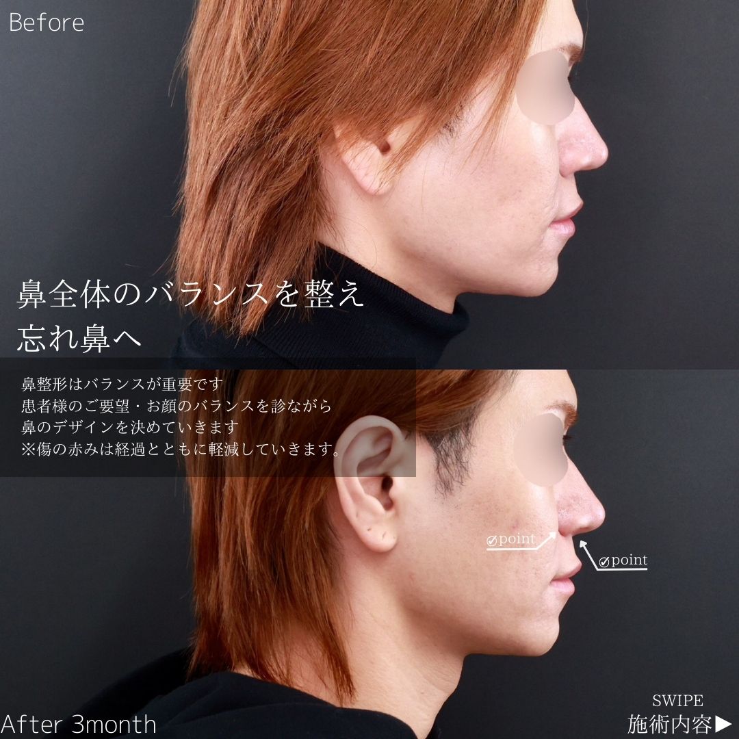 鼻孔縁挙上術/鼻翼挙上術/TAC式 鼻翼縮小術（小鼻縮小）の症例写真 施術前後 