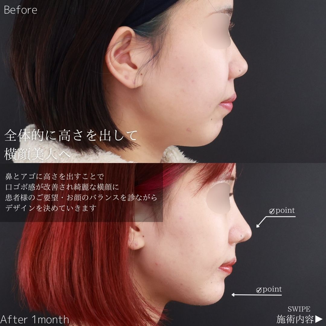 鼻尖形成・鼻尖縮小/鼻先軟骨移植/鼻中隔延長術の症例写真 施術前後 