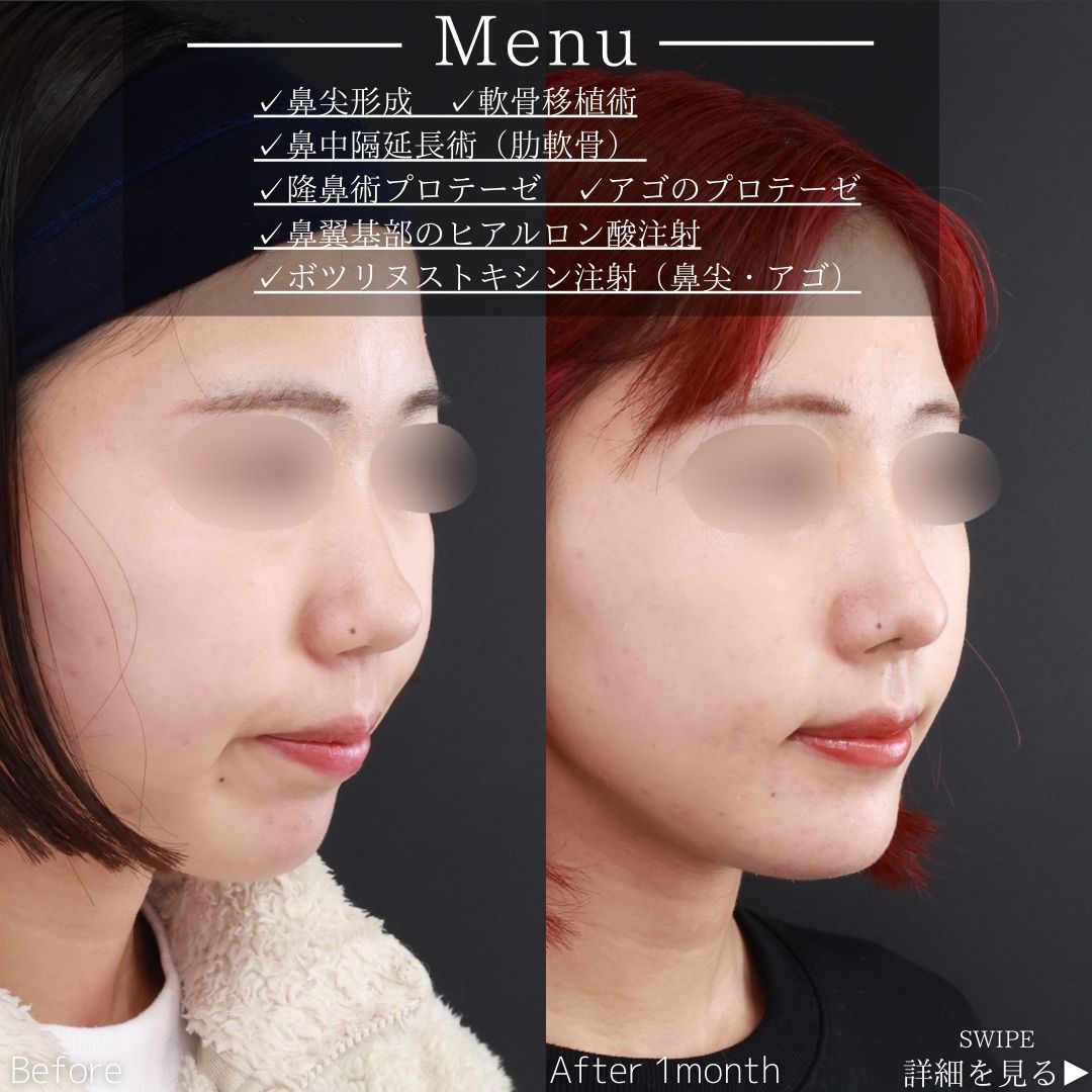 鼻尖形成・鼻尖縮小/鼻先軟骨移植/鼻中隔延長術の症例写真 施術前後 