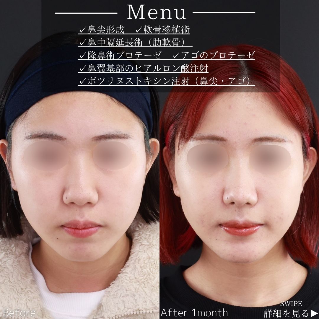 鼻尖形成・鼻尖縮小/鼻先軟骨移植/鼻中隔延長術の症例写真 施術前後 