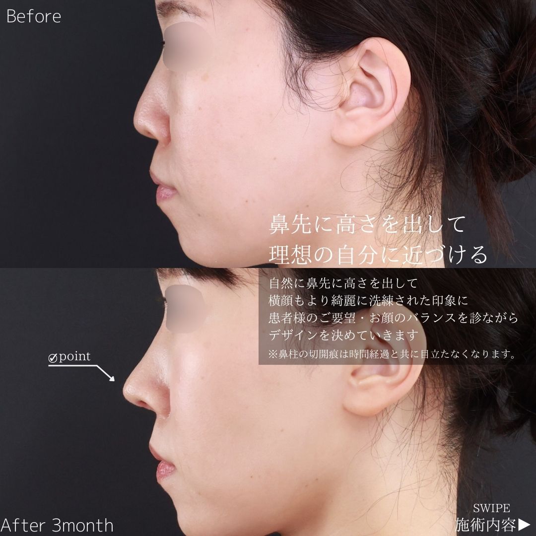 鼻尖形成・鼻尖縮小/鼻先軟骨移植/鼻中隔延長術の症例写真 施術前後 