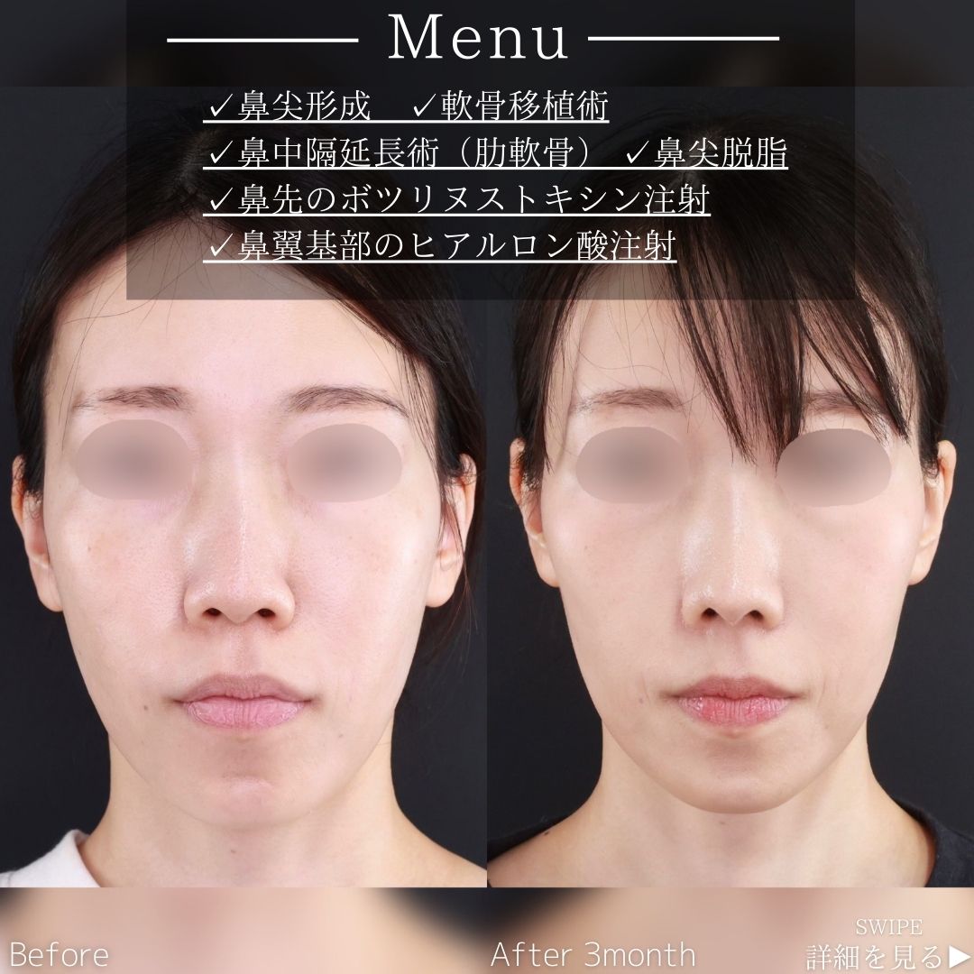 鼻尖形成・鼻尖縮小/鼻先軟骨移植/鼻中隔延長術の症例写真 施術前後 