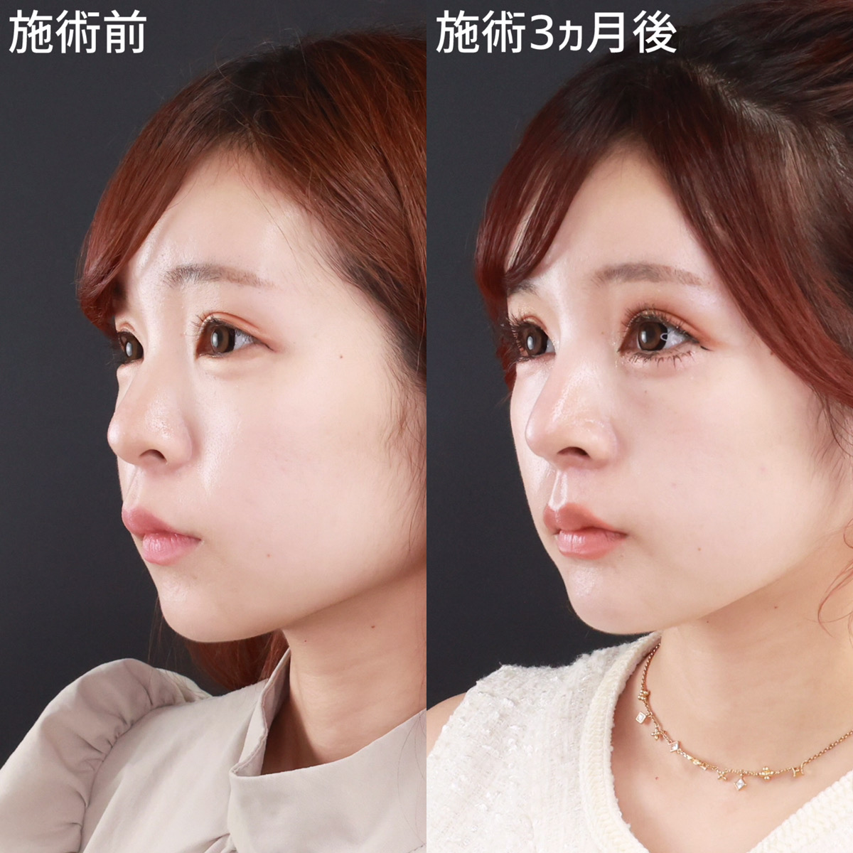 鼻中隔延長術/鼻先軟骨移植/鼻尖形成・鼻尖縮小の症例写真 施術前後 