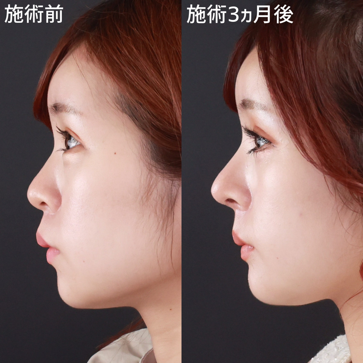 鼻中隔延長術/鼻先軟骨移植/鼻尖形成・鼻尖縮小の症例写真 施術前後 