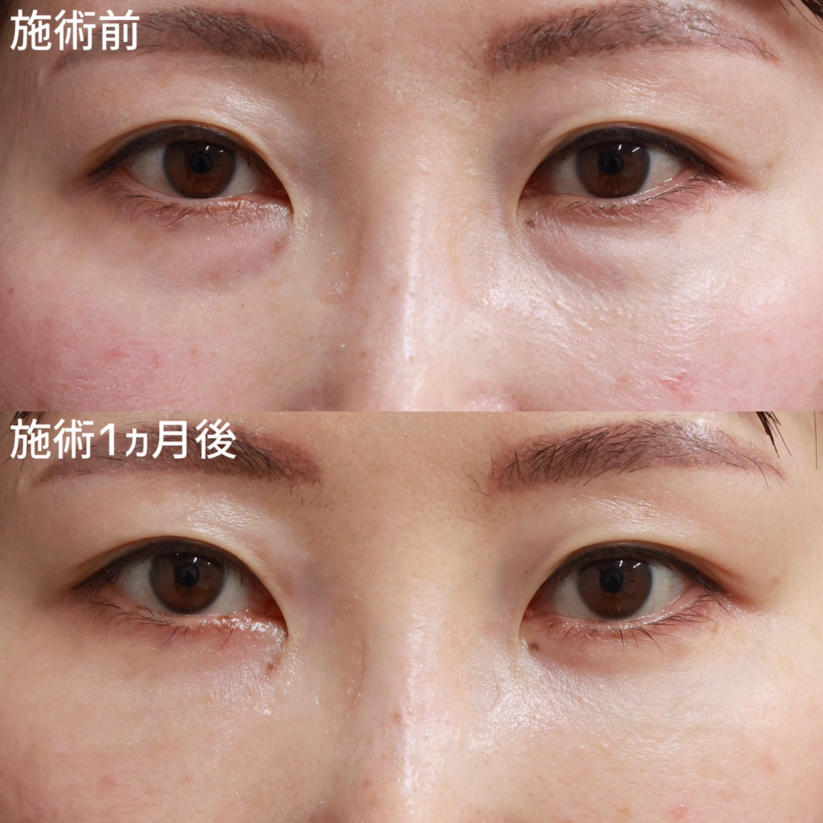 【裏ハムラ法】明るい目元に大変身！