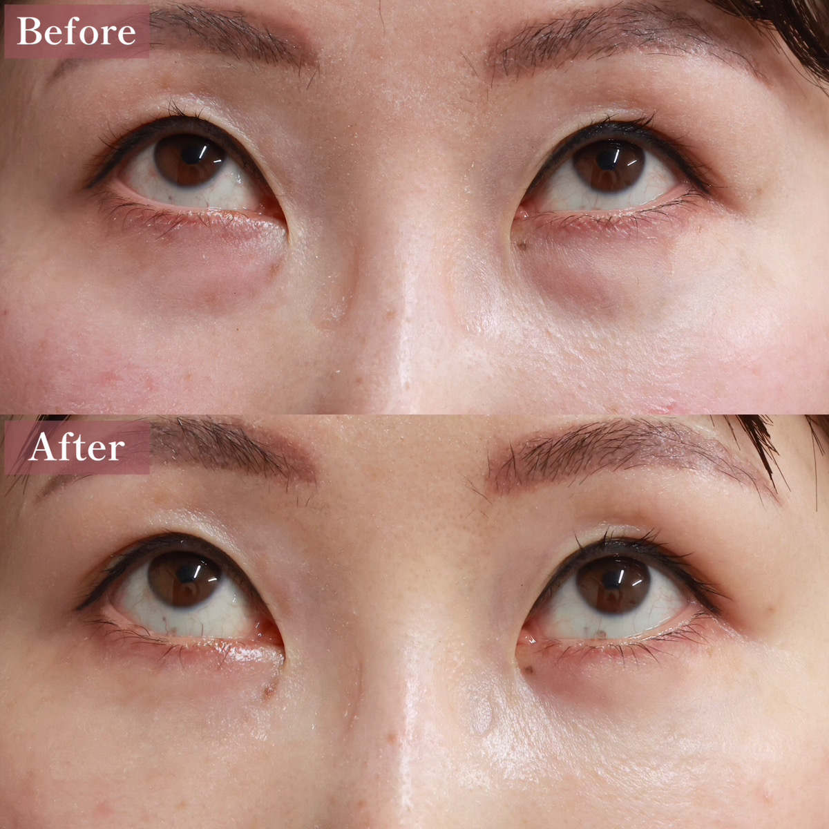 下眼瞼脱脂術（目の下のたるみ取り・目の下の脂肪ふくらみ取り）の症例写真 施術前後 