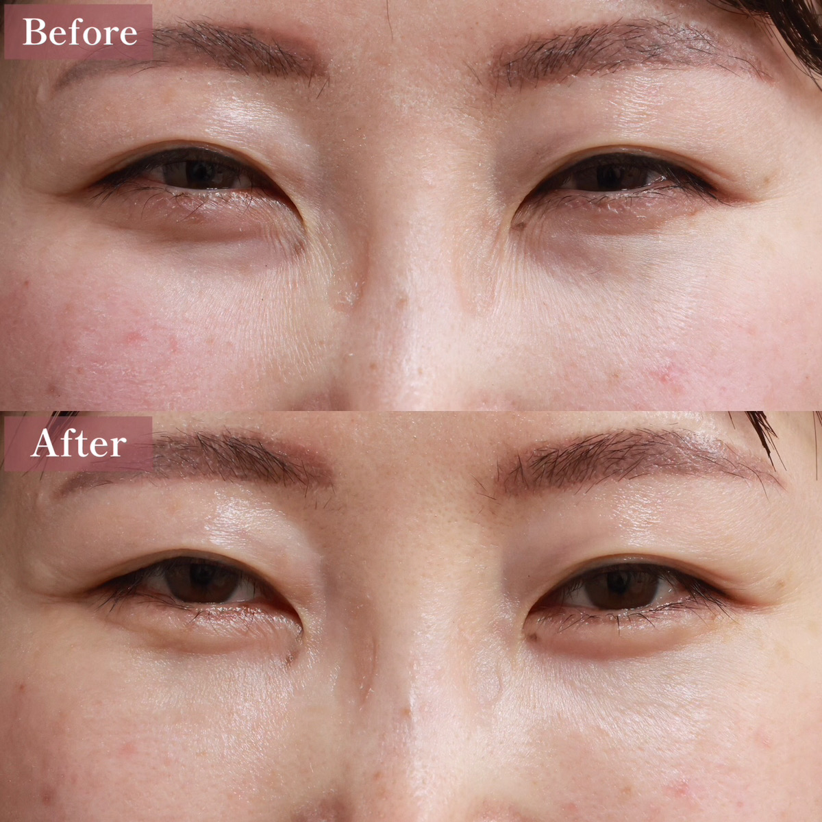 下眼瞼脱脂術（目の下のたるみ取り・目の下の脂肪ふくらみ取り）の症例写真 施術前後 