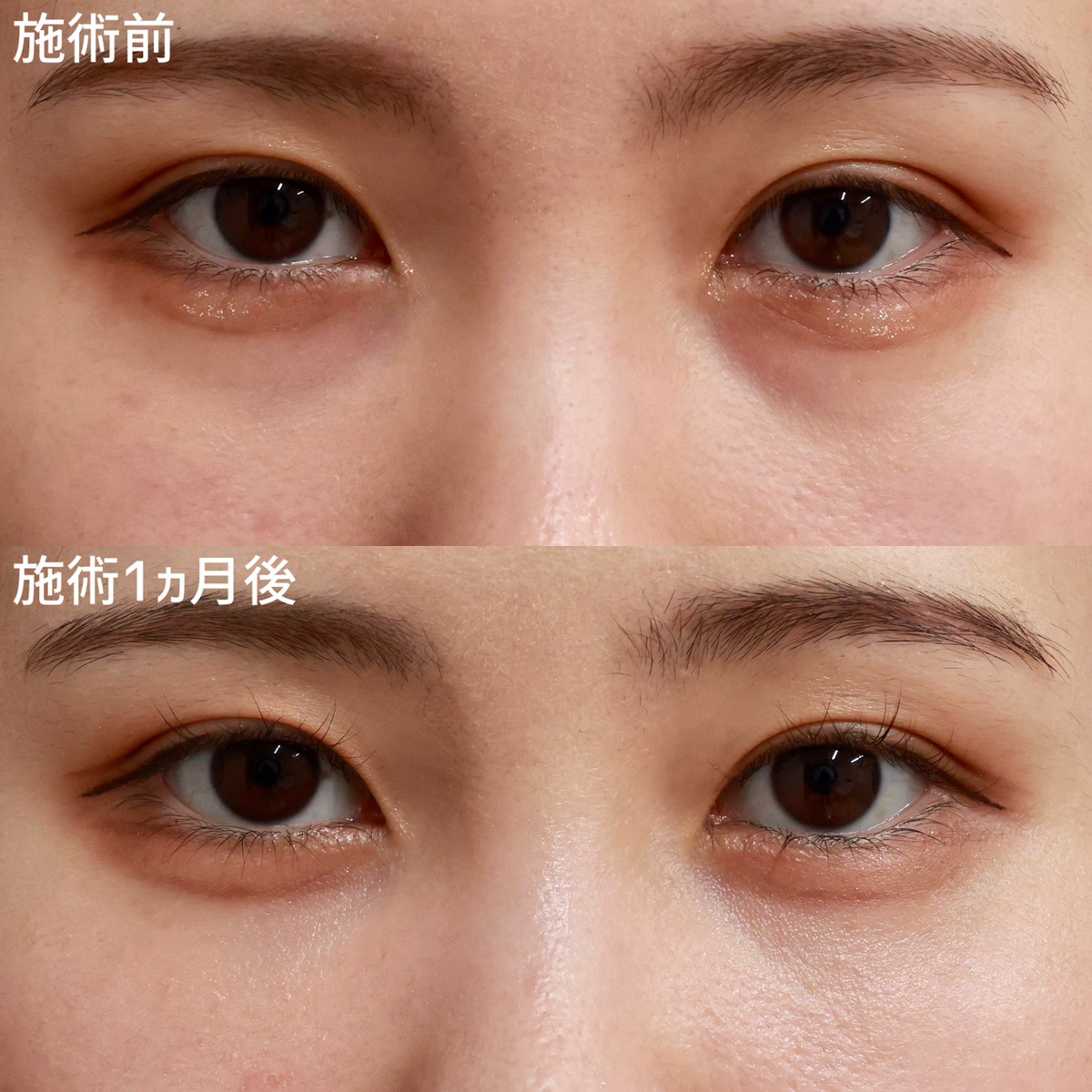 【裏ハムラ法】目の下のクマを改善し可愛い目元！