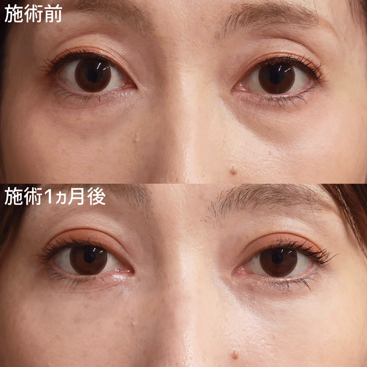 下眼瞼脱脂術（目の下のたるみ取り・目の下の脂肪ふくらみ取り）の症例写真 施術前後 