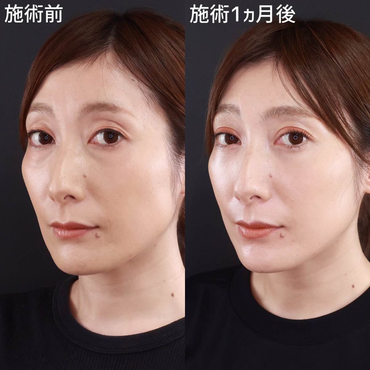 【裏ハムラ法】若々しく自信が持てる目元