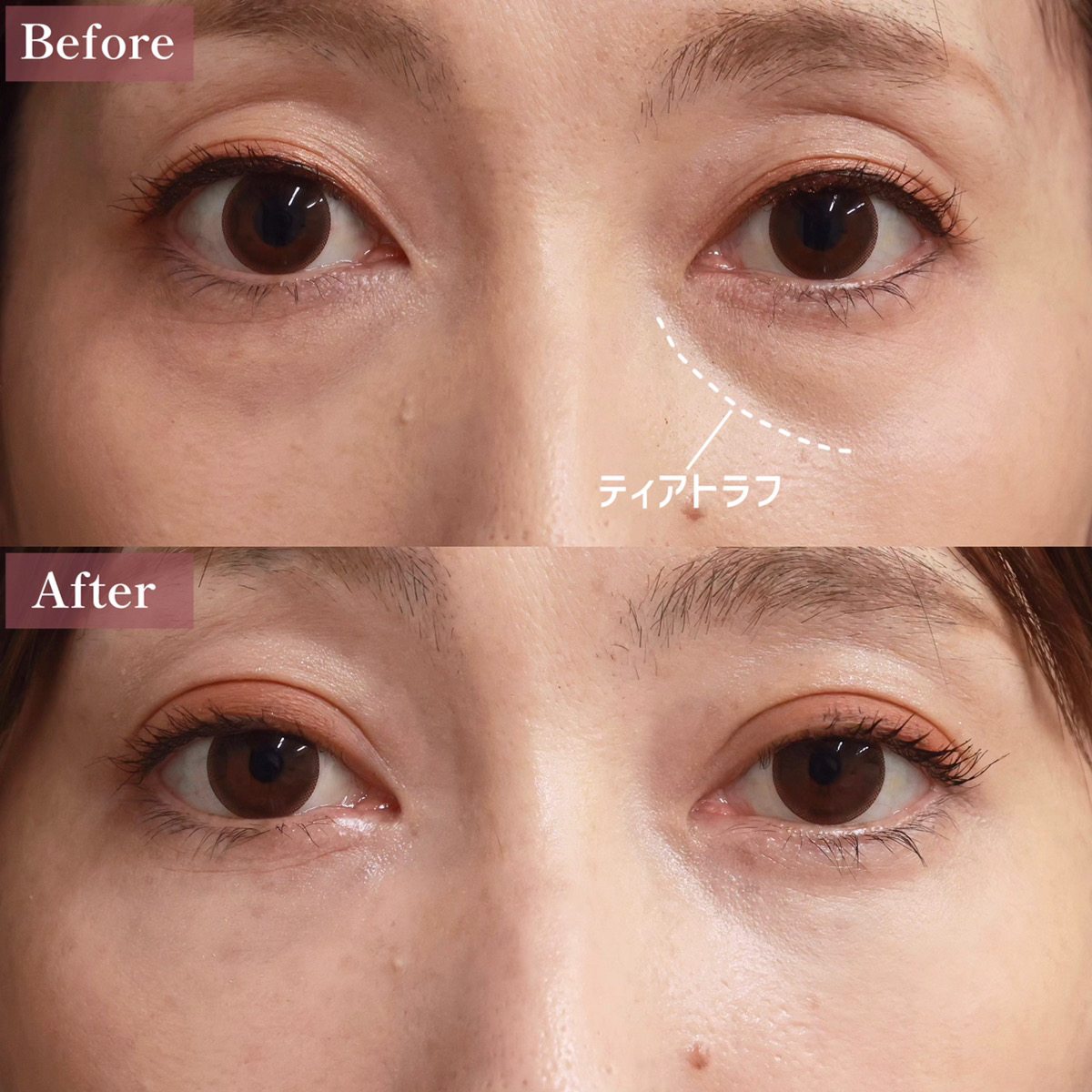 下眼瞼脱脂術（目の下のたるみ取り・目の下の脂肪ふくらみ取り）の症例写真 施術前後 