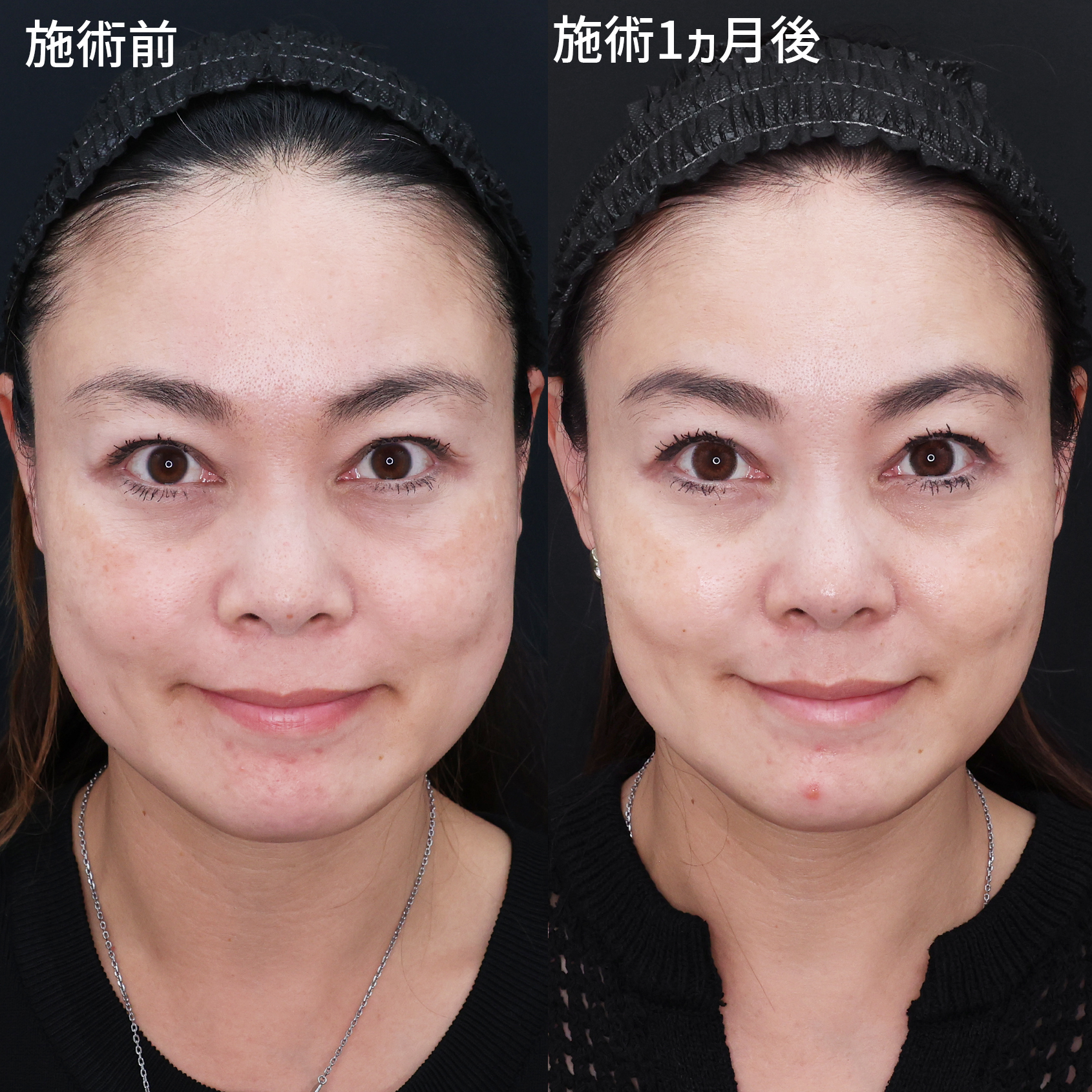 【脂肪除去】余白スッキリ！笑顔もより魅力的に◎